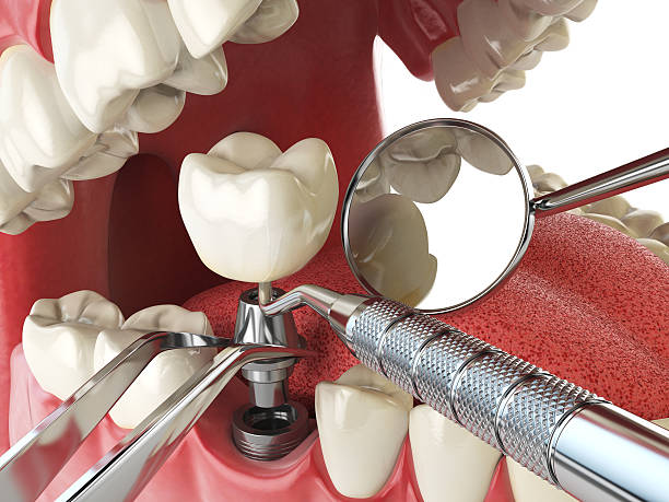 Best Emergency Dentist for Lost Fillings or Crowns in Jerome, ID